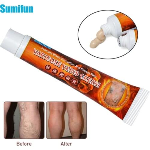 Sumifun 20g Varicose Veins Treatment Cream Varicosity Angiitis Ointment Relief Veins Pain Phlebitis Medical Plaster Health Care