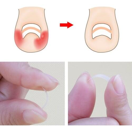10pcs Ingrown Toenail Correction Tool Ingrown Toe Nail Treatment Elastic Patch Sticker Straightening Clip Brace Pedicure Tool