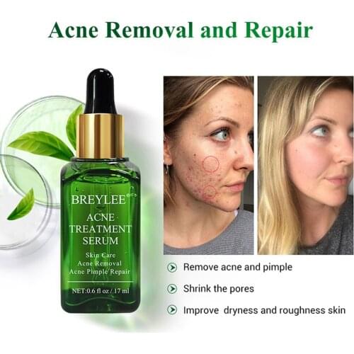 BREYLEE Tea Tree Acne Treatment Face Serum Reduce Acne Scars Essence Oil Control Moisturizer Brighten Shrink Pores Beauty Liquid