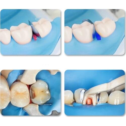 SuperGood Dental Sectional Matrix Contoured Matrices System Ring Clamps Clip Composite Ztdental Autoclavable