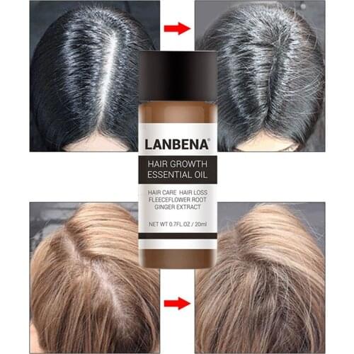 20ml Effective Hair Growth Essence Improves Hair Texture Increase Nutrition Fashion Hair Growth Fluid Hair Growth Ointment Fast