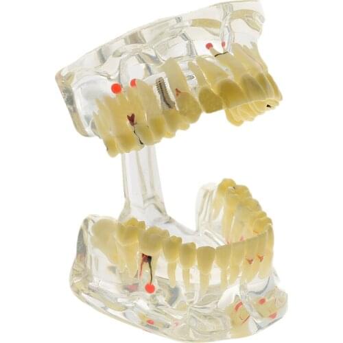 Implant Disease Teeth Model with Restoration Bridge Dentist for Science Disease Teaching Study
