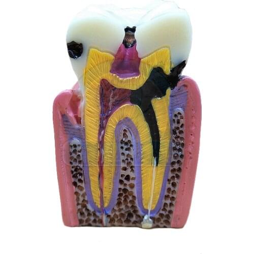 Dental Caries Disassembing Comparation Developing Teeth Model Implant Model Pulp Disease Clinical Model Sagitally Section Model