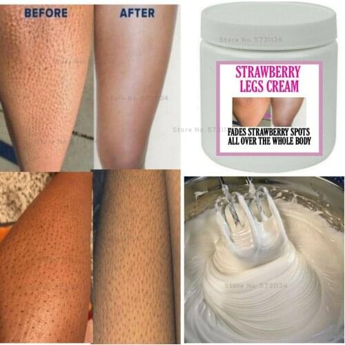 New Strawberry Legs Fading Cream, Helps Fade Strawberry Spots, Stawberry Legs
