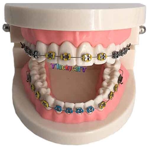 1pcs Dental Orthodontic Tooth Model Treatment With Ortho Ceramic Bracket Arch Wire Buccal Tube Ligature Ties for teaching