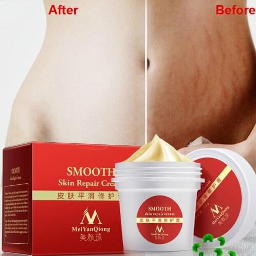 Maternity Stretch Marks Scar Removal Cream Remove Scar Body Skin Repair Care Postpartum Pregnancy Serum Smooth Skin Creams