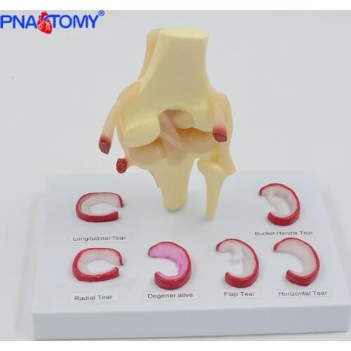 Life Size Knee joint model with ligaments shows meniscus tears Medical Teaching Tool Anatomical Model Skeleton Anatomy