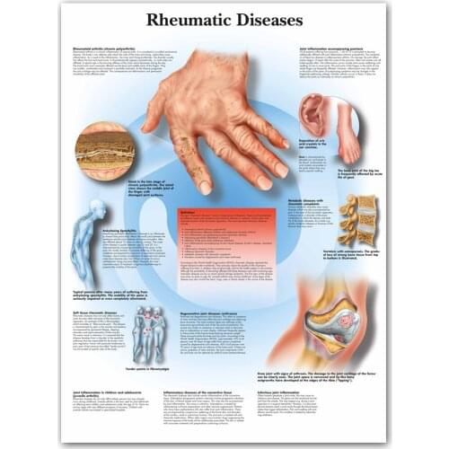 WANGART Rheumatic Diseases Chart Poster Print Body Map Canvas Wall Pictures for Medical Education Home Decor