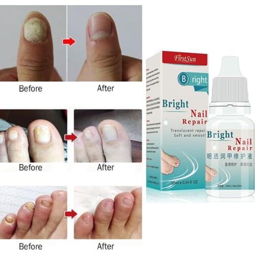 10ML Herbs Fungal Nail Treatment Toe Nail Fungus Removal Gel Moisturizing Nail Polish Onychomycosis Nail Repair Liquid TSLM2