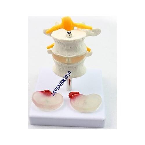 Human Anatomical Anatomy Lumbar Vertebra Diseased Contrast Medical Model