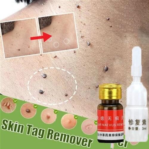 Mole & Skin Tag Removal Solution Painless No Trace Mole Skin Dark Spot Removal Face Wart Tag Freckle Removal Cream Oil Plaster