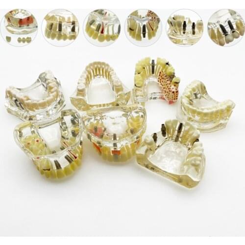 Dental Implant Model With Bridge & Caries Dental Study Teach Teeth Model Dental Teaching Resources