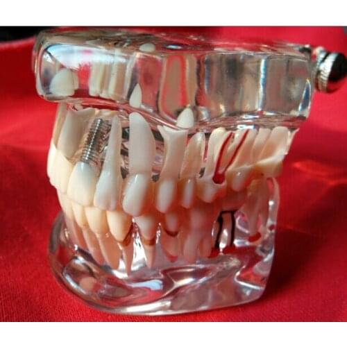 Teeth model dental activity pathological model removable dental teeth model dental tooth model
