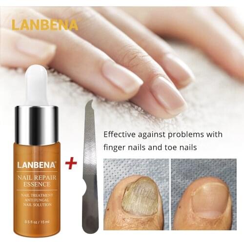 Fungal Nail Treatment Repair Essence Nail and Foot Hand Care Whitening Toe Nail Anti Fungus Removal Infection Nail Products