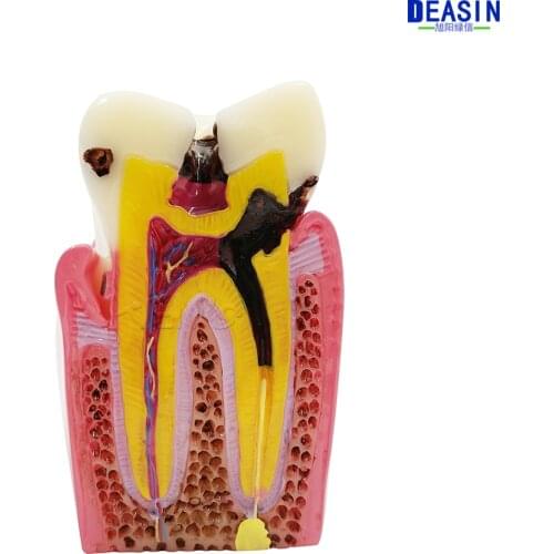 High Quality 2016 NEW Denture Teeth model 6X, caries comparison model, tooth decay model,Dentist for Medical Science Teaching