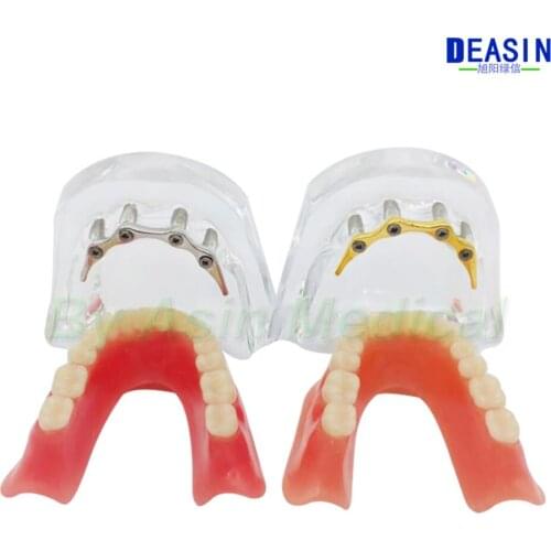 1 pc x high quality Resin Coverage dental implant model dentures Removable teeth model for dentist study Deasin