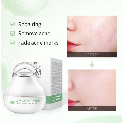 Herbal Acne Repair Cream Moisturizing Salicylic Acid Anti Acne Face Cream Smooth Skin Acne Scar Treatment Facial Essence