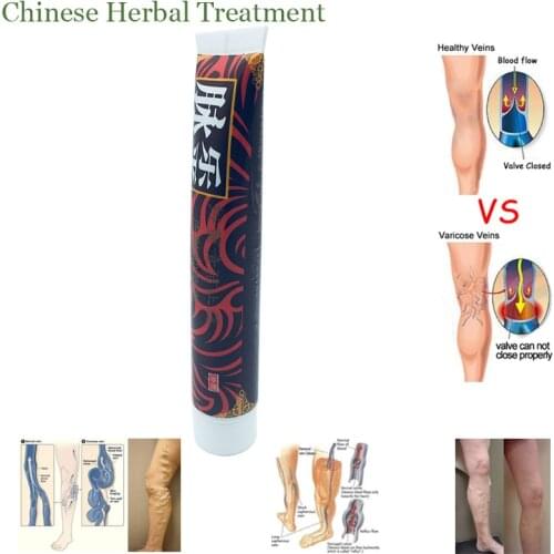 100% original Veins Varicose Treatment Plaster Treatment Leg Acid Bilges Itching Earthworm Lumps Old Bad Leg Vasculitis
