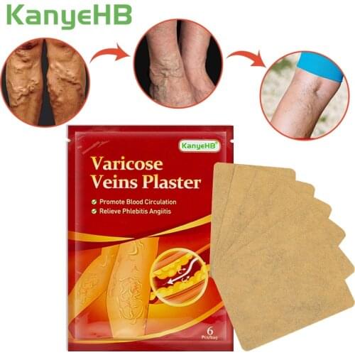 6pcs Varicose Veins Plaster Treatment Vasculitis Phlebitis Spider Leg Pain Sticker Herb Medical Patch Angiitis Removal Patch