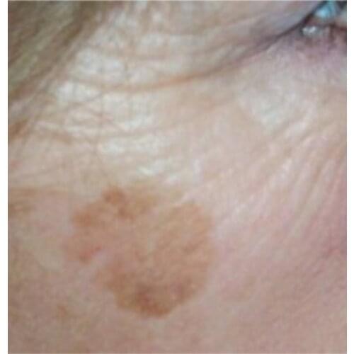 Korean 100 Ml Sun Spot, Age Spot, Brown Spot, Dark Spot Remover/Treatment, Corrector NO SCAM