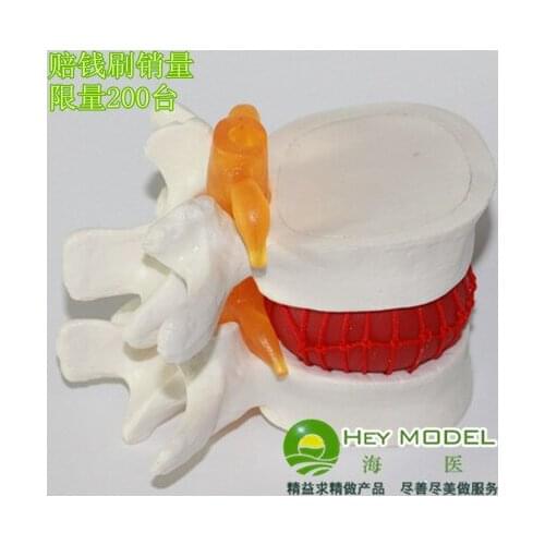 Lumbar spine model human lumbar disc herniation model human skeleton model