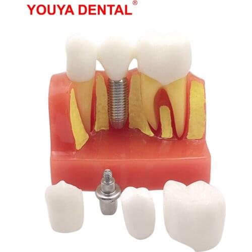 Dental Model Resin 4times Tooth Implant Model For Studying Teaching Module Medical Science Oral Dentist Dentistry Products Red