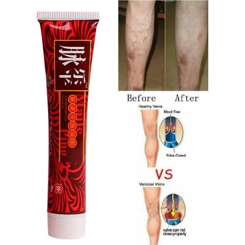 Varicose Veins Treatment Cream Effective Vasculitis Phlebitis Spider Veins Varicosity Angiitis Treatment Ointment Herbal Cream
