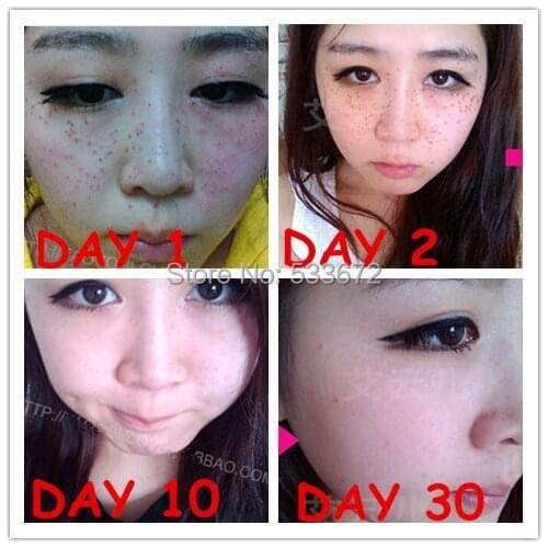 Orignal Chinese Medication Speckle Freckle Moles Wart Remove Water Speckle Freckle Seamless Water Drops Skin Tags Removal Cream