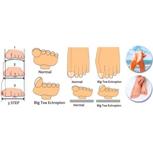 2 pcs Silicone Toe Bunion Hallux Valgus Feet Care Regulator Finger Toes Thumb Hole Protectors Set Top Quality