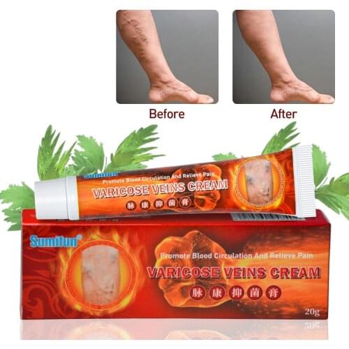 Varicose Veins Treatment Cream Ointment Vasculitis Phlebitis Spider Veins Pain Varicosity Angiitis Remedy Removal Herbal Cream