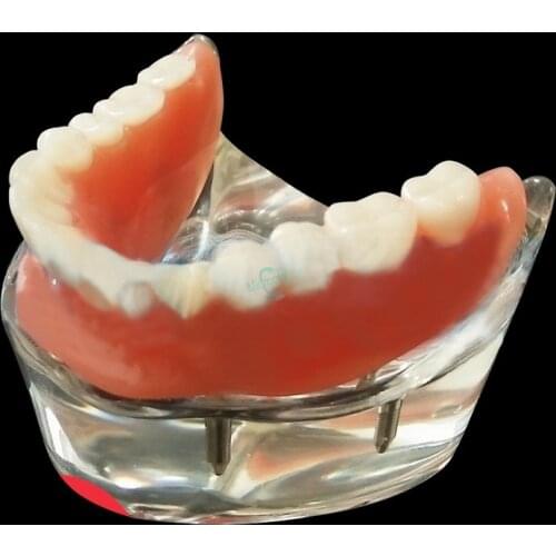 1Pc Dental 4 Implant Teeth Study Model Overdenture Inferior Demo Model