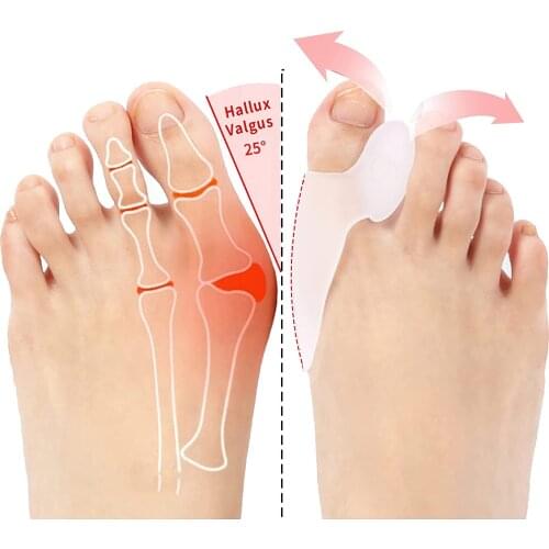 Bunion Corrector for Men and Women Toe Splints Soft Gel Cushion Toe Spacers Toe Separators Hallux Valgus Pain Relief 2Pcs