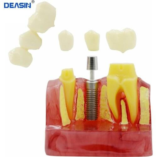 4 Times Teeth Model Dental Implant Analysis Crown Bridge Demonstration Dental Teeth Model Dentist Tools Study Model