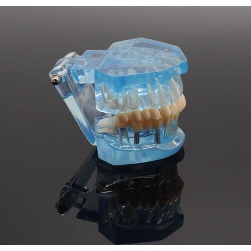 Dentistry Study Tooth Model Adult Pathological teaching Teeth model Caries