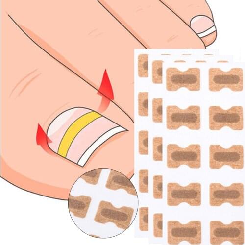 10Pcs Breathable TPU Ingrown Nail Correction Sticker Toe Nail Repair Paronychia Treatment Recover Reduce Pain Toe Health Care