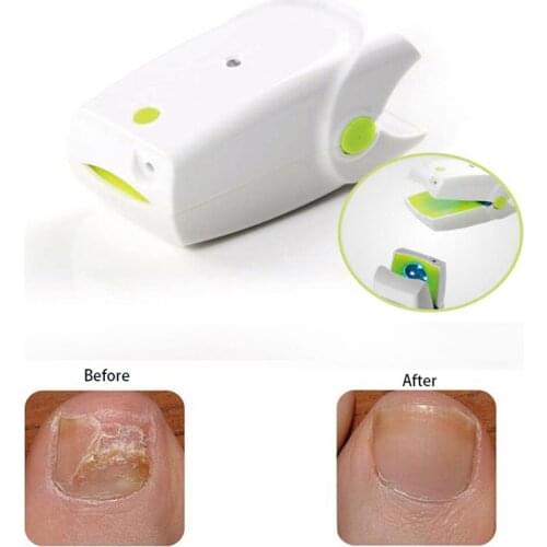 Anti Fungal Nail Support Toenail & Fingernail Fungus Solution Better Nail Restoring Fungal Nail Renewal Treatment Cold Laser