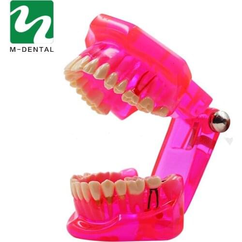 1 PC Dental Study Tooth Model Detachable Adult Pathological Teaching Teeth Model Transparent red