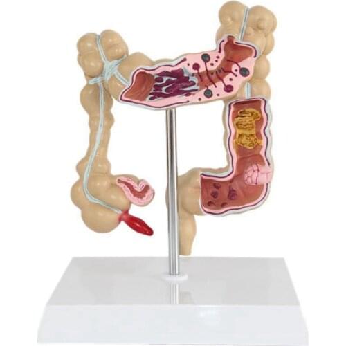 Colorectal Lesion Model Human Colon Large Intestine Pathological Diseases Model Medical Mrganizer Anatomy