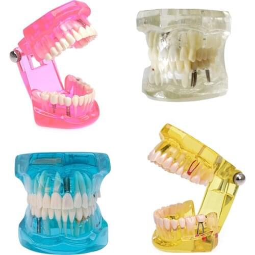 Colorful 1 PC Dental Implant Disease Teeth Model with Restoration Bridge Tooth Dentist for Medical Science Teaching