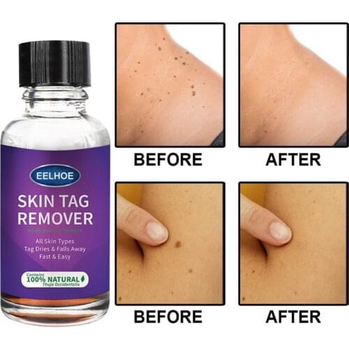 30ML Wart Treatment Papillomas Removal of Warts Draw Liquid From Skin Tags Removing Against Moles Remover Anti Verruca Remedy