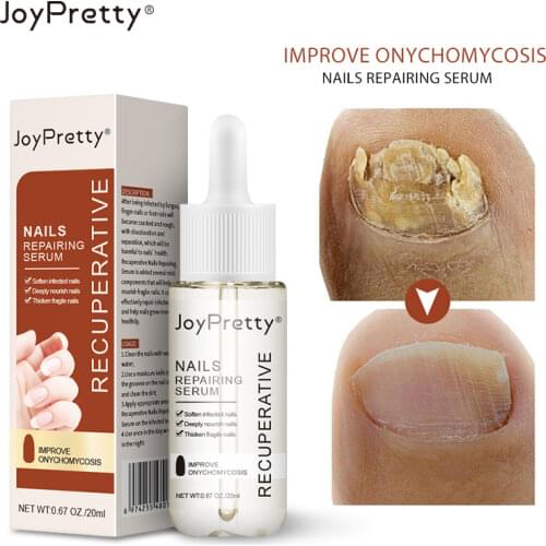 JoyPretty Fungal Nail Treatment Serum Onychomycosis Paronychia Anti-Fungal Toe Fungus Nail Foot Removal Gel Essence Feet Care