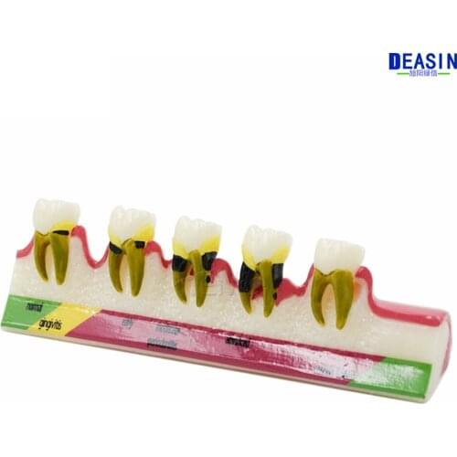 High Quality Dental Periodontal Disease assort Teeth Dentoform Typodont Study Teaching Model