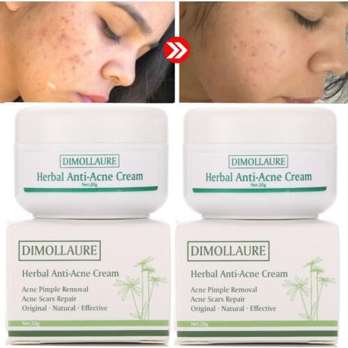 Dimollaure Anti-acne cream Face cream acne treatment Comedone Pimple Acne Scar Blackhead Removal Oil control Skin care whitening