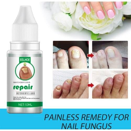 Nail Fungus Treat Onychomycosis Toe Treat Feet Care Nail Repair Anti Infections Paronychia Onychomycosis Nails Care