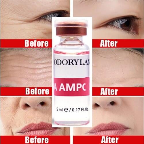 10 Vials Cross-linked HA Hyaluronic Acid Pure Micro Molecular Mesotherapy Collagen Hyaluronic Acid Whitening BB Cream Serum