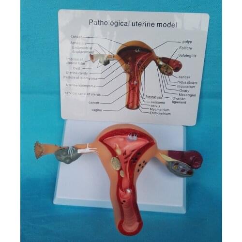 Female Pathological Uterus Model Anatomy of The Structure of The Womb
