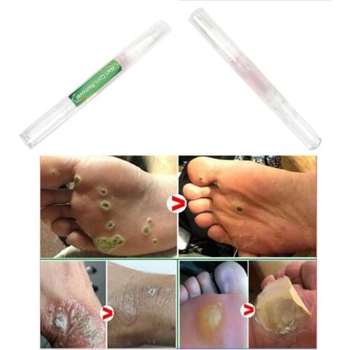 3ml Removal Of Warts Liquid From Skin Tags Removing Against Wart Corn Remove