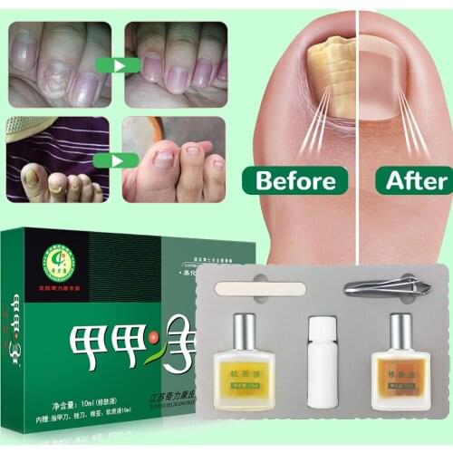 Nail Fungal Treatment Feet Care Essence Nail Foot Whitening Toe Nail Fungus Removal Gel Anti Infection Paronychia Onychomycosis