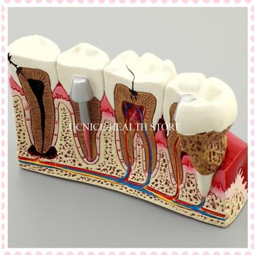 Dental root canal tooth model M4029/4Times Dental Pathologies teeth Model show Caries apicitis root canal treatment