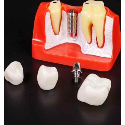 1pc 4 times planting solution model Detachable bridge crown for Demonstration planting repairing dental mold